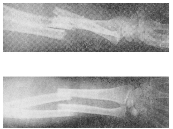 1277_x ray of fractures.jpg