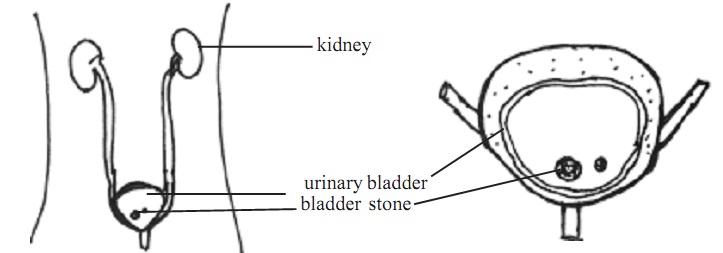 2191_kidney stone.jpg