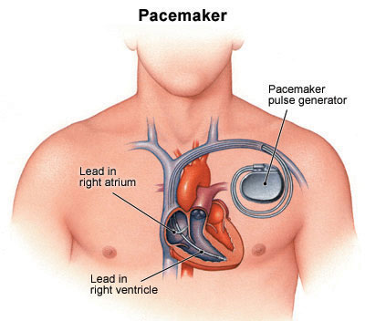 562_pacemaker.jpg